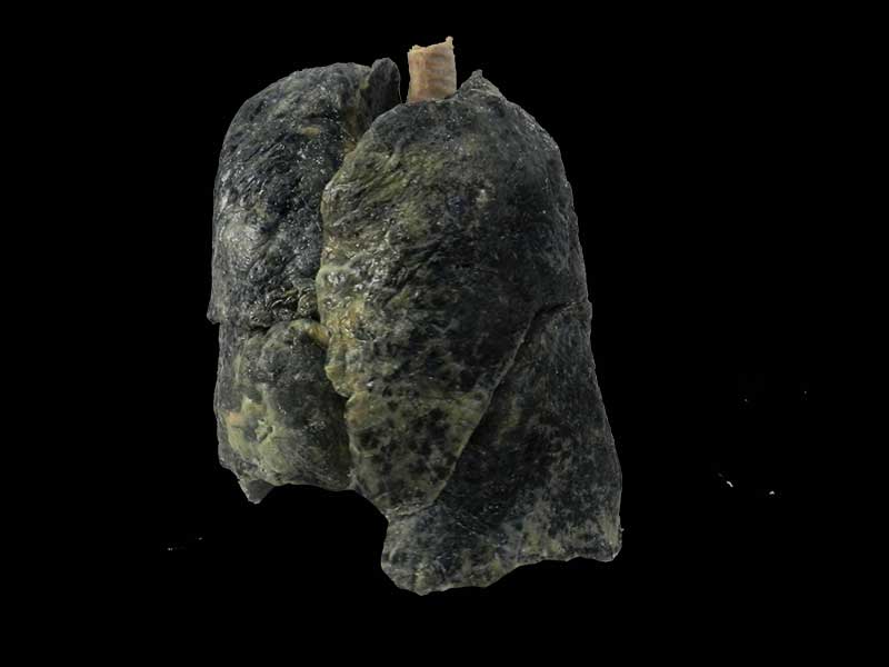 Smoker lung plastinated specimen ,lung plastinated specimens, plastination, medical teaching model