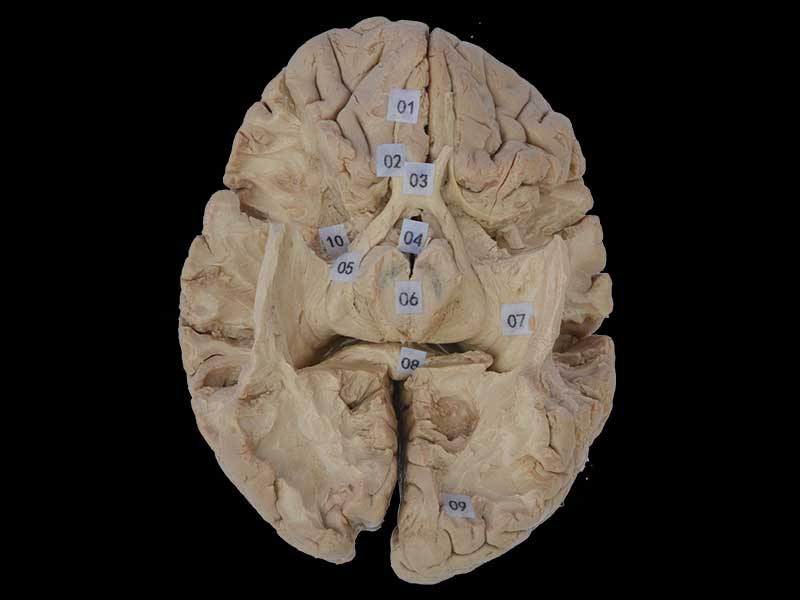 Tractus opticus and optic radiation plastination