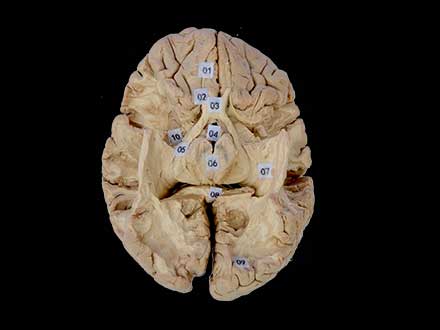 Tractus opticus and optic radiation plastination