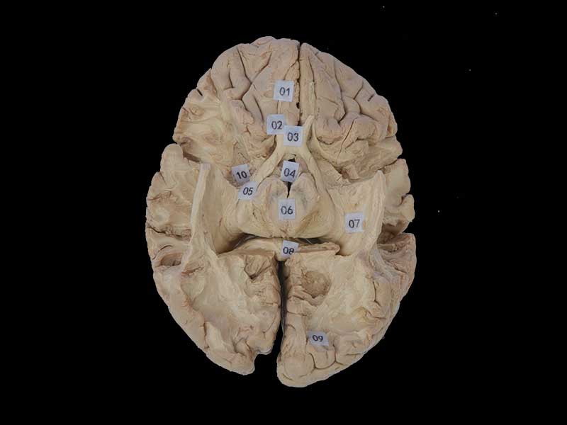 Tractus opticus and optic radiation