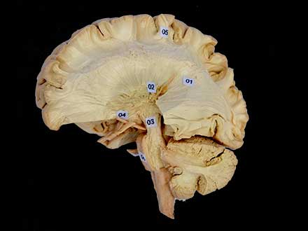 Tractus pyramidalis and cerebellar peduncle