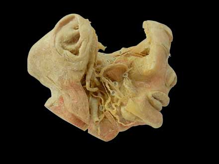 trigeminal nerve plastination