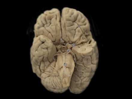 arteries of base of the brain plastinated specimens