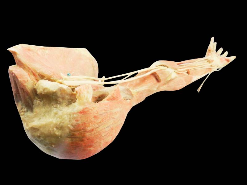 Deep arteries  of upper limb teaching specimen