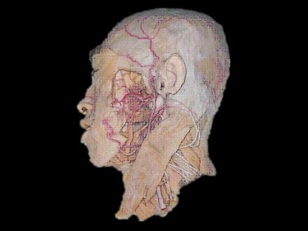 External carotid artery and its branches plastinated specimens