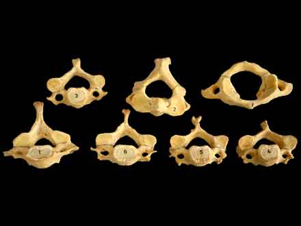 Cervical vertebra