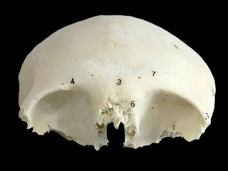 human frontal bone specimen