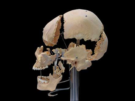 separated human skull plastination with teeth
