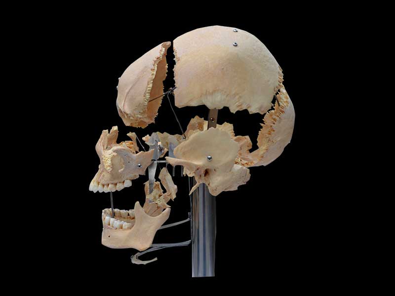separated human skull plastination with teeth