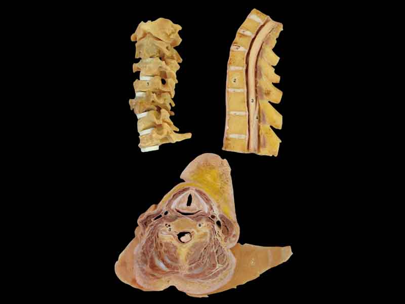 uncovertebral joint plastinated specimen