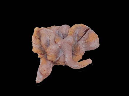 Ileocecal Adenocarcinoma Model