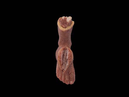 Malignant Hemangioendothelioma of Dorsal Foot Model