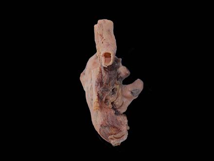 Malignant Pleural Mesothelioma Model