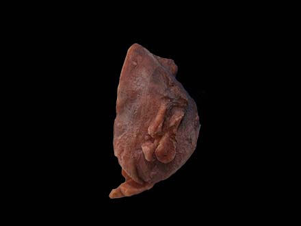 Multiple Uterine Fibroids Model
