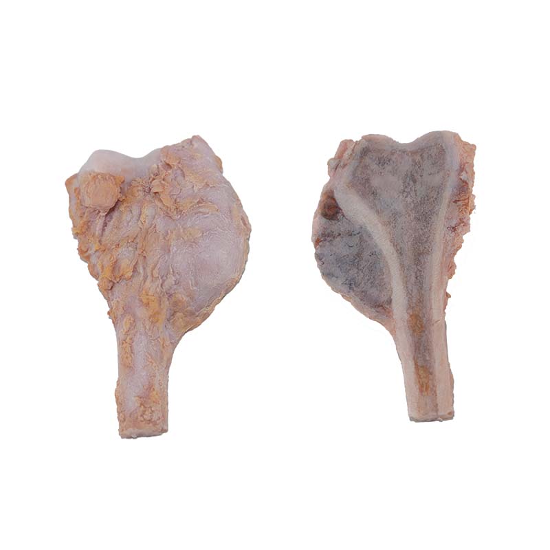 osteosarcoma pathological anatomy model