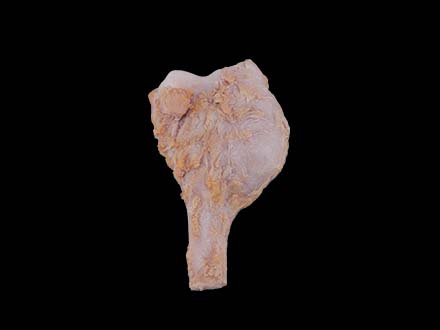 Osteosarcoma Specimen