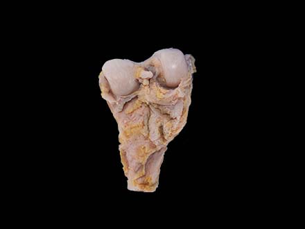 Osteosarcoma Model