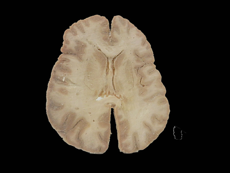 plastinated horizontal section of brain