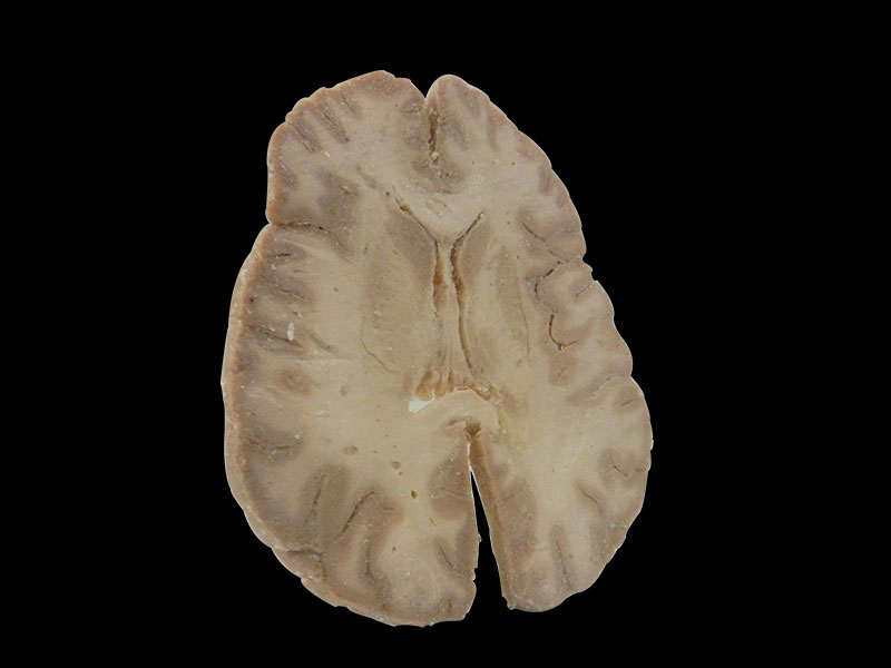 plastination horizontal section of brain 