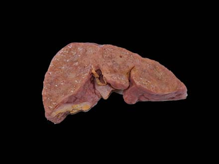 Portal Cirrhosis Complicated with Cell Carcinoma Model