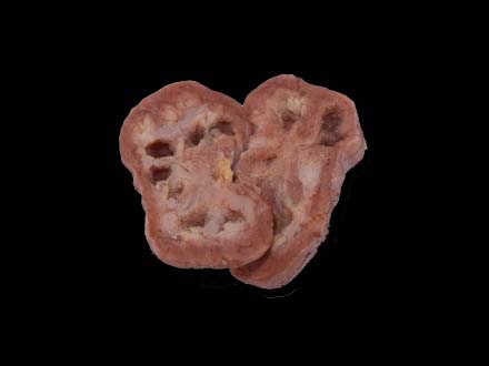 renal tuberculosis