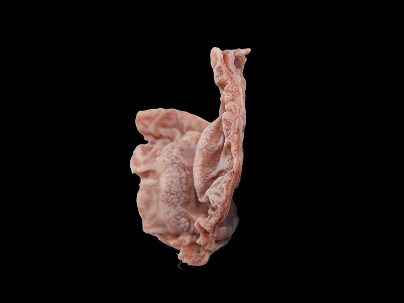 Silicone Ulcerative Gastric Cancer Model