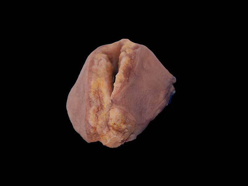 Simulated Breast Cancer Model