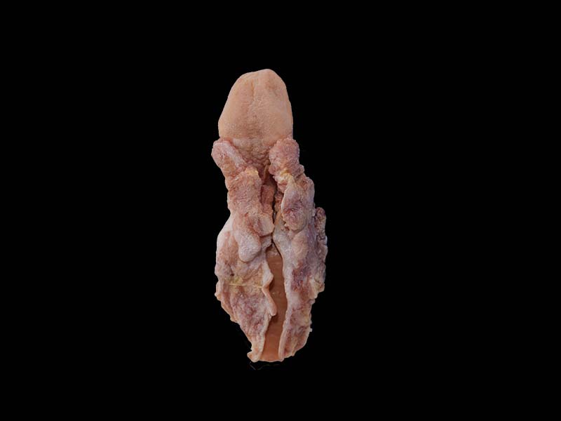 Simulated Esophageal Cancer Model