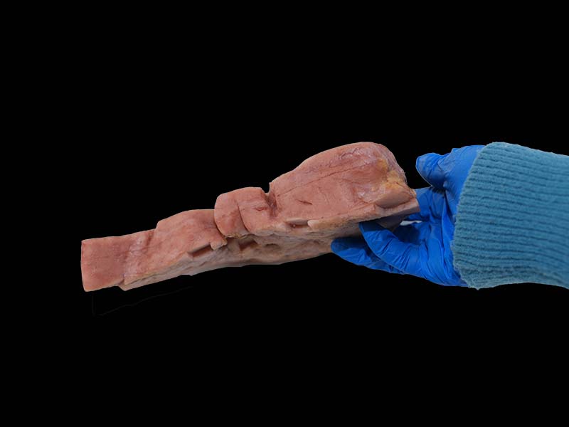 Simulated Hepatic Vascular Endothelial Cell Sarcoma Model