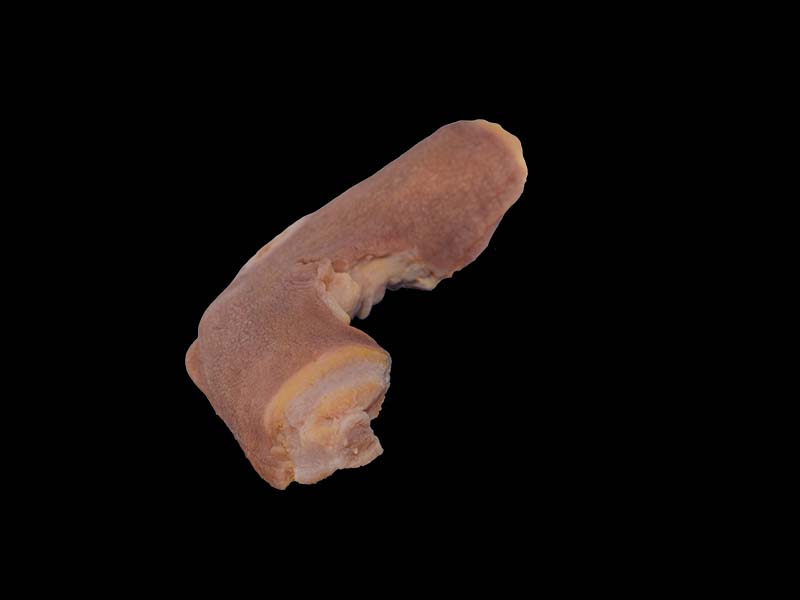 Simulated Hodgkin's Disease Model