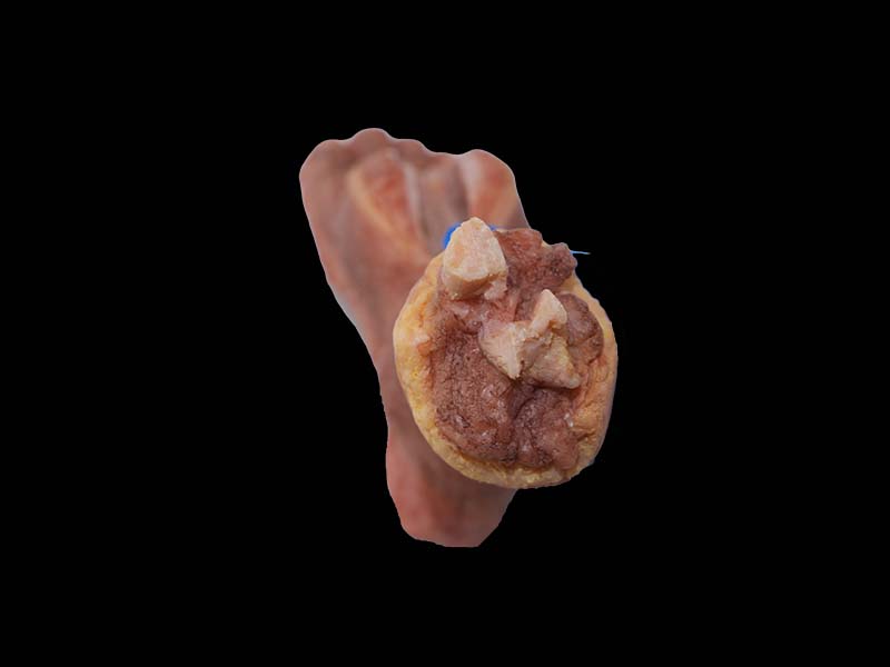 Simulated Malignant Hemangioendothelioma of Dorsal Foot Model