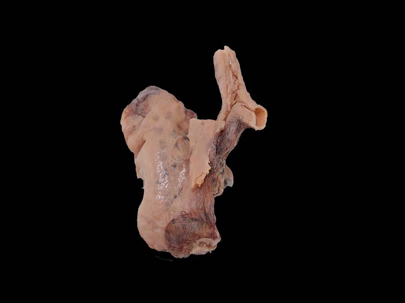 Simulated Malignant Pleural Mesothelioma Model