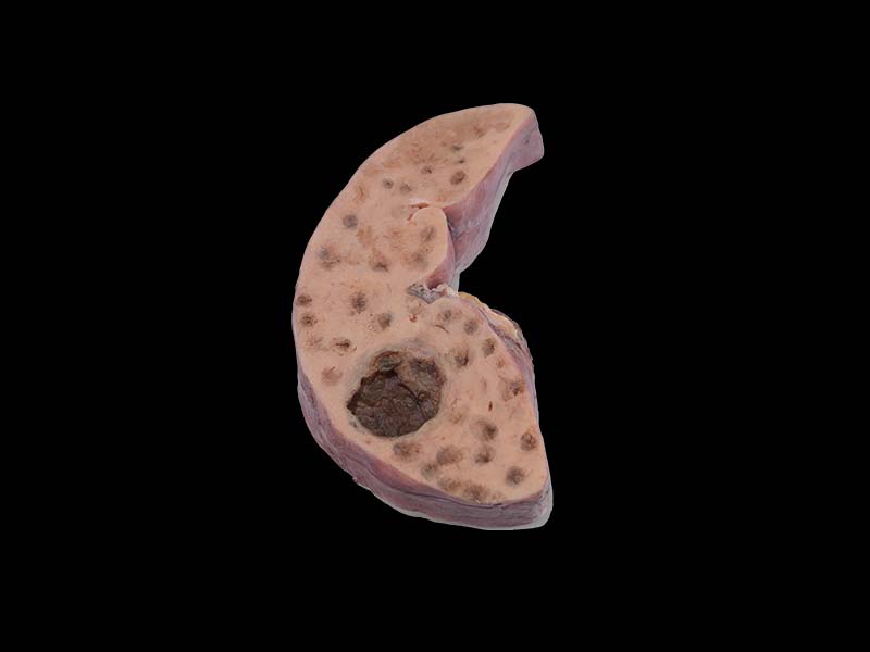 Soft Bile Duct Epithelial Liver Cancer Model