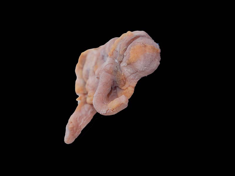 Soft Ileocecal Adenocarcinoma Model