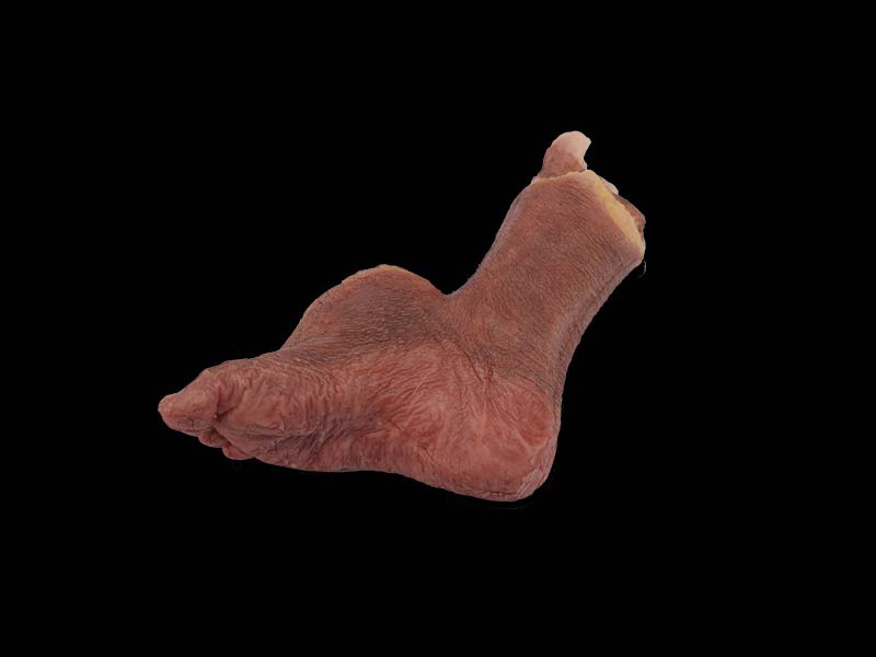 Soft Malignant Hemangioendothelioma of Dorsal Foot Model