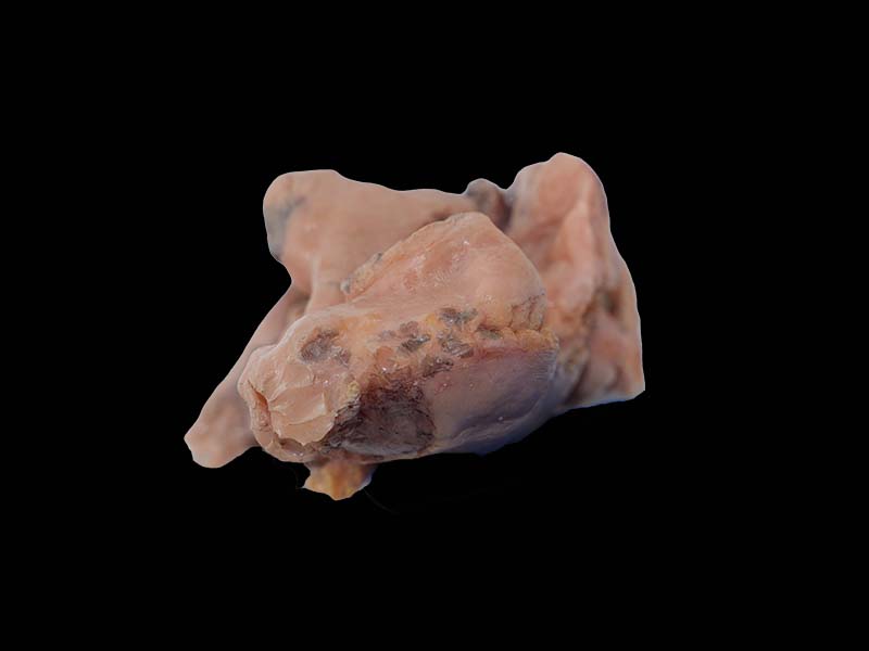 Soft Malignant Pleural Mesothelioma Model
