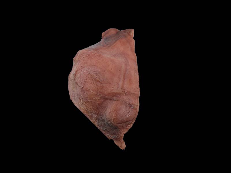 Soft Multiple Uterine Fibroids Model