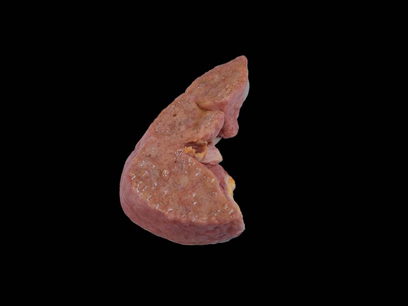 Soft Portal Cirrhosis Complicated with Cell Carcinoma Model