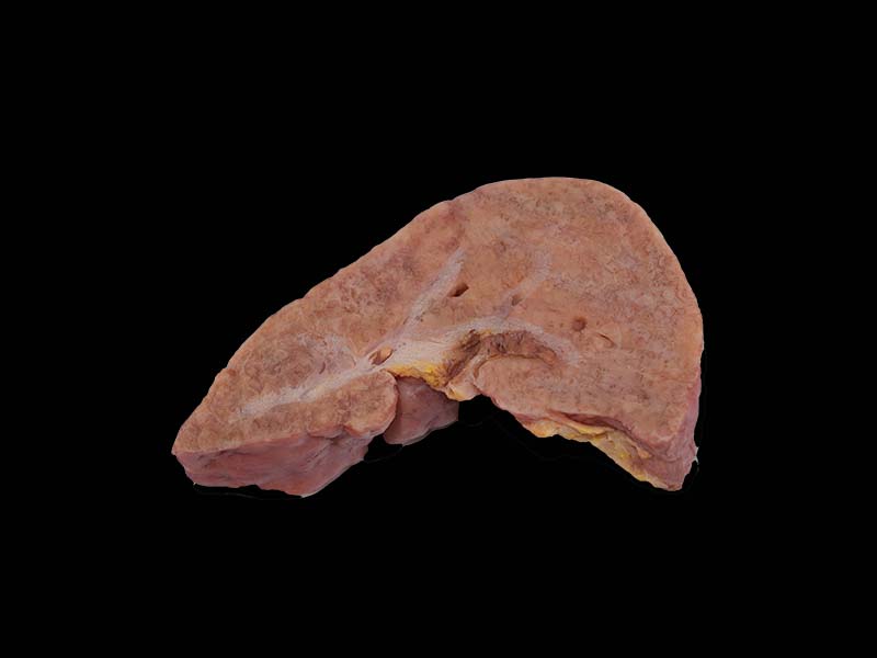 Soft Portal Cirrhosis Complicated with Cell Carcinoma Silicone Model