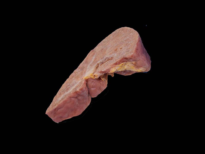 Soft Portal Cirrhosis Complicated with Cell Carcinoma Simulation Model