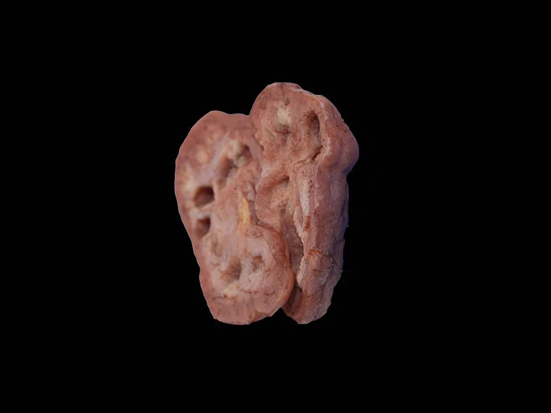 Soft Renal Tuberculosis Model