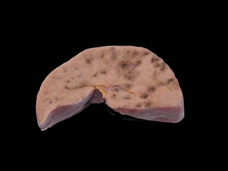 Soft Silicone Bile Duct Epithelial Liver Cancer Model