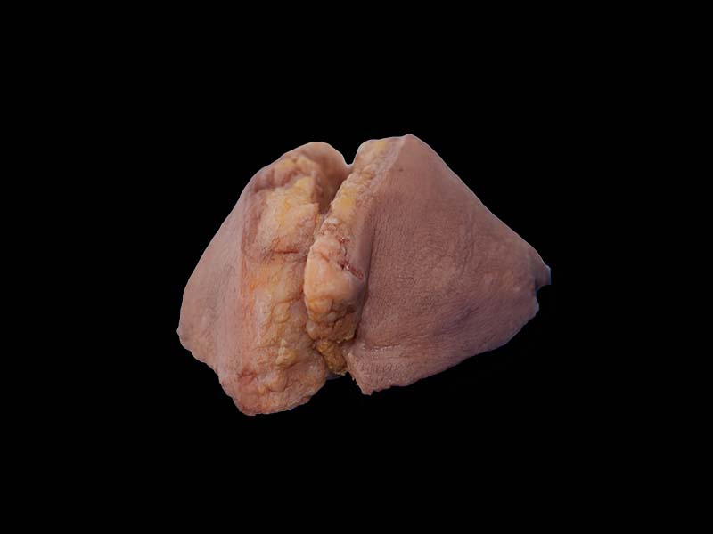 Soft Silicone Breast Cancer Model