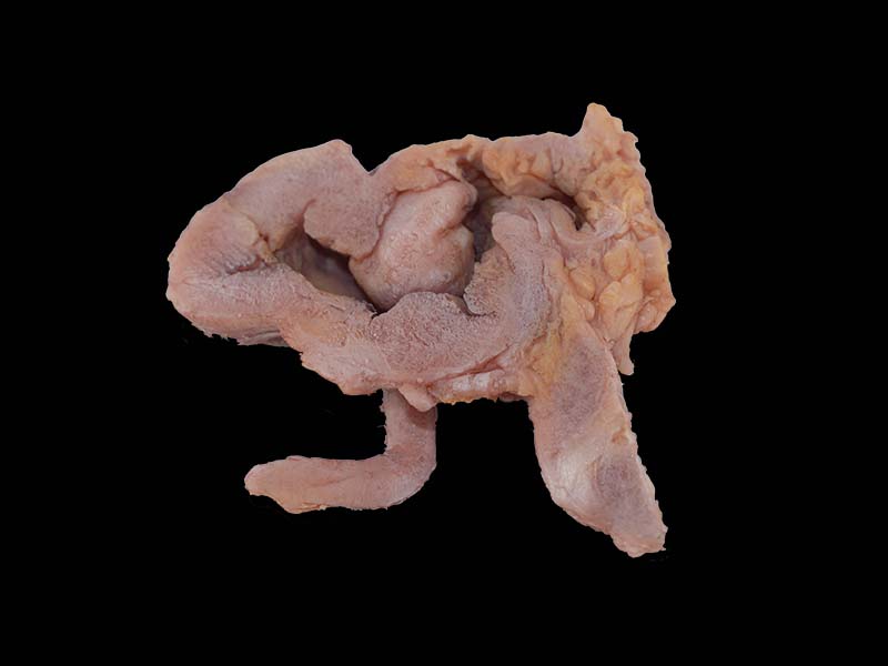 Soft Silicone Ileocecal Adenocarcinoma Model