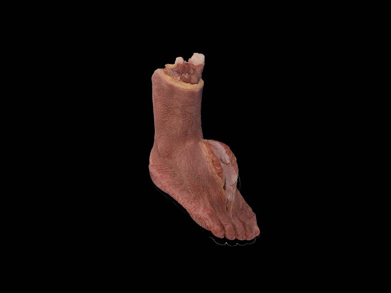 Soft Silicone Malignant Hemangioendothelioma of Dorsal Foot Model