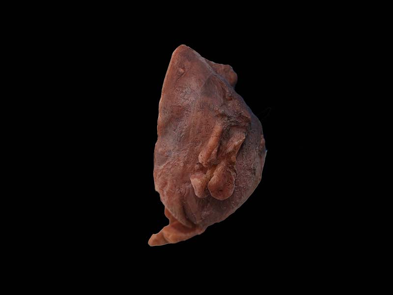 Soft Silicone Multiple Uterine Fibroids Model