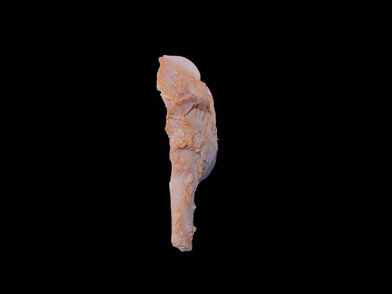 Soft Silicone Osteosarcoma Model