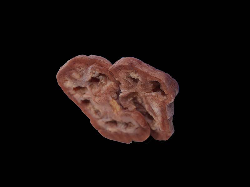 Soft Silicone Renal Tuberculosis Model