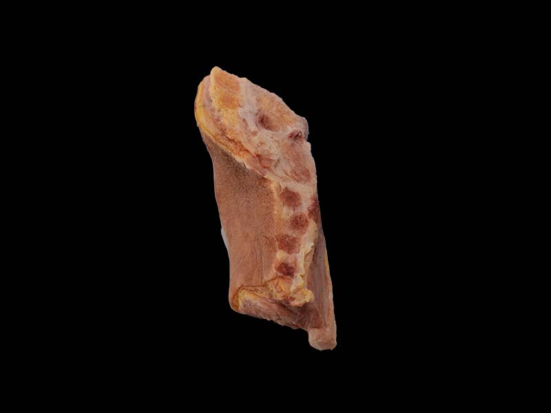 Soft Silicone Tuberculosis of Knee Joint Model