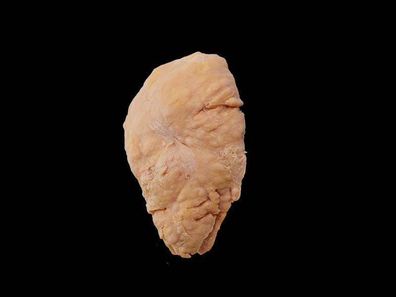 Soft Silicone Uterine Leiomyoma Model